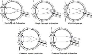astigmatism myopia simplex